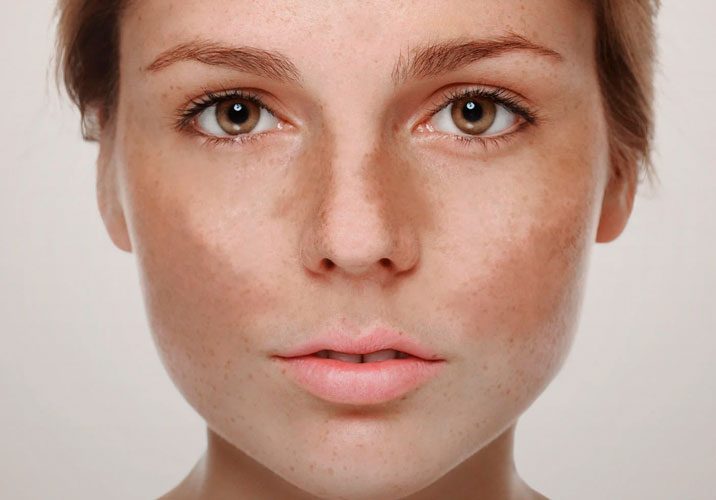 melasma